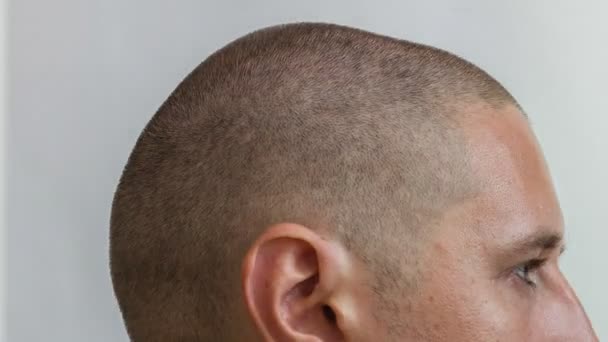 Male head - process of growing hair of young caucasian man — Stock Video