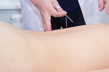 Akupunktur tedavisi alan genç kadın. İğneler. Yakın çekim