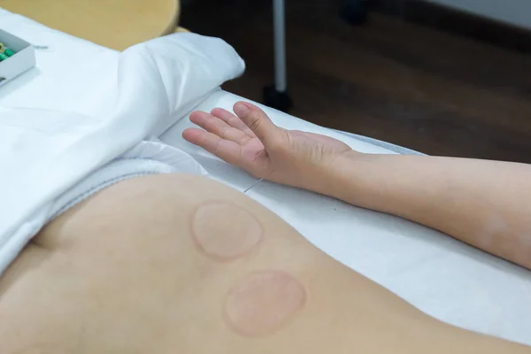 Junge Frau, die eine Akupunkturbehandlung macht. Nadeln in der Hand. Nahaufnahme — Stockfoto