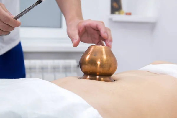 Uma mulher a fazer um tratamento de medicina alternativa. Procedimento de moxioterapia. Métodos chineses. Colocar uma tigela na barriga — Fotografia de Stock