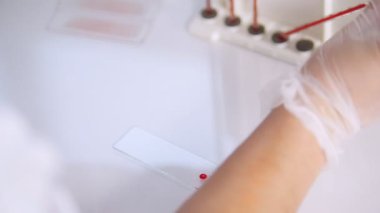 Sağlık kliniği. Bir kan testi. Camına kan damlayan ve örnek taşlama