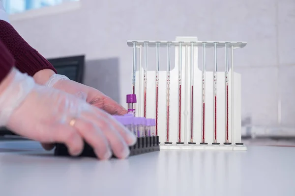 Medical clinic. Nurse put a stand with test tubes near the pipettes filled up with blood