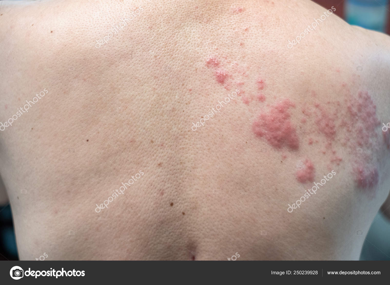 Герпес высыпания на теле фото