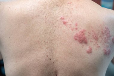 Zona (hastalık), Herpes zoster, varicella - zoster virüsü. Cilt 
