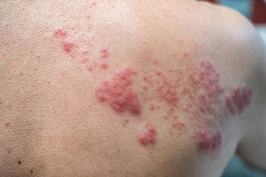 Zona (hastalık), Herpes zoster, varicella - zoster virüsü. Cilt 