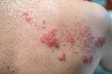 Shingles (Disease), Herpes zoster, varicella-zoster virus. skin  clipart