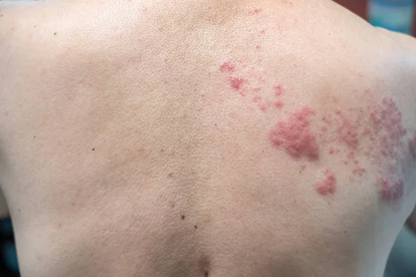 Zona (hastalık), Herpes zoster, varicella - zoster virüsü. Cilt 