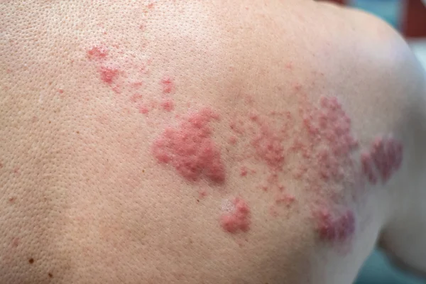 Zona (hastalık), Herpes zoster, varicella - zoster virüsü. Cilt 