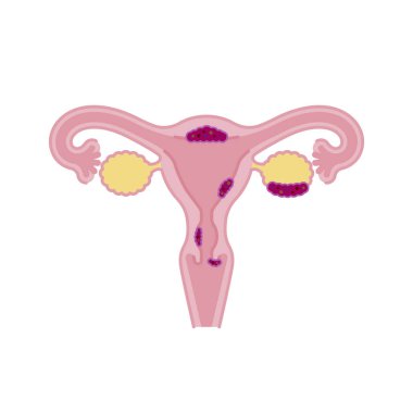 Simple illustration of uterine cancer/front view (image material) clipart