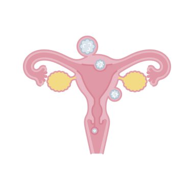 Simple illustration of uterine fibroid - front view (image material) clipart
