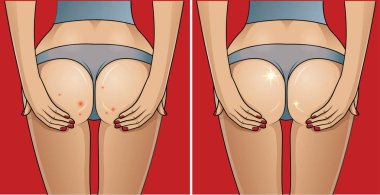 Kadının kalça ile sorunlu cilt. Önce - sonra kavramı.