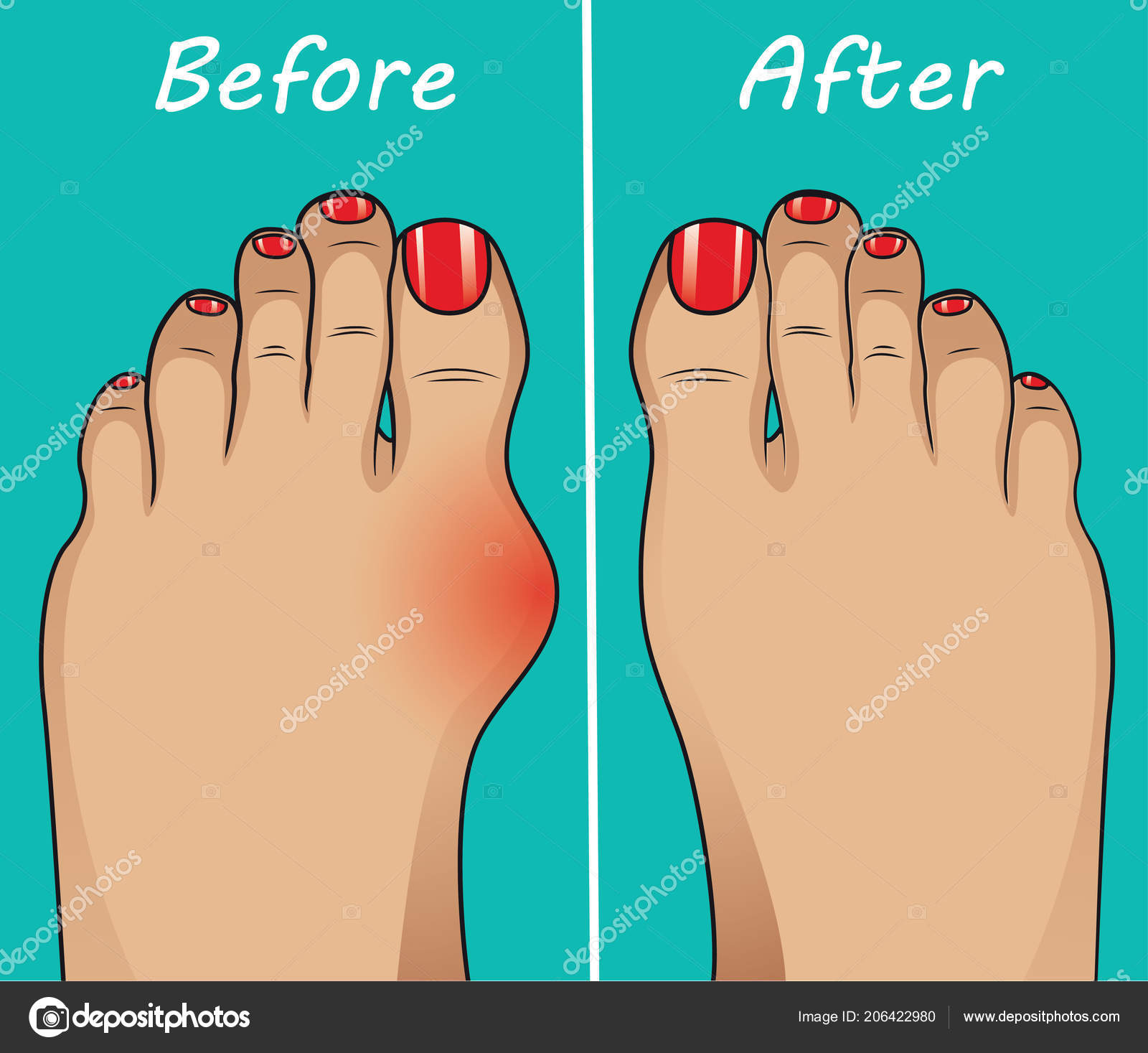 Bunion Operation Vector Illustration Stock Vector Image by