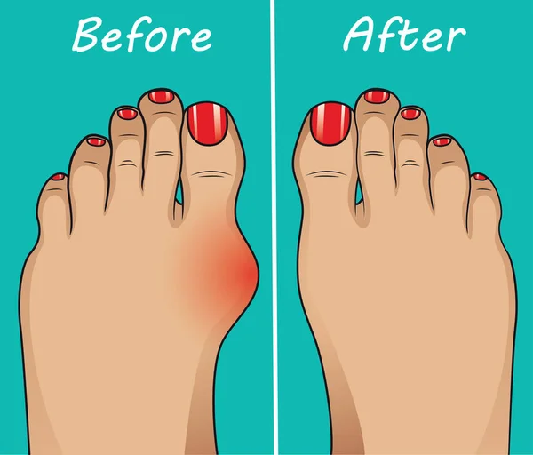 Bunion Operation Vector Illustration — Stock Vector