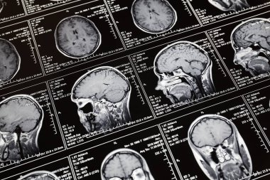 Manyetik rezonans taraması beynin. MRI kafa tarama.