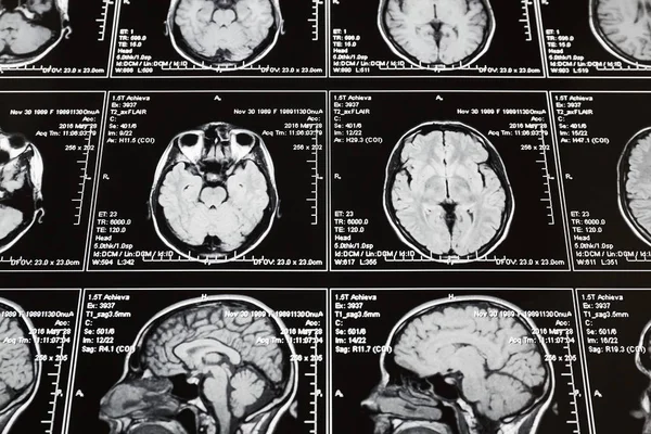 Exploración Por Resonancia Magnética Del Cerebro Resonancia Magnética Craneal — Foto de Stock