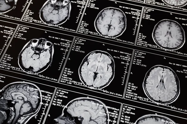 Resonansi Magnetik Memindai Otak Scan Kepala Mri — Stok Foto