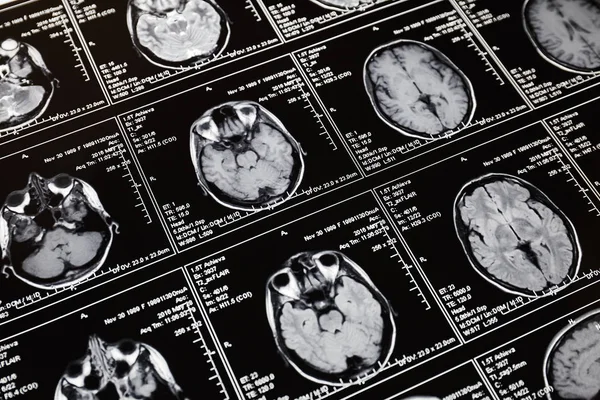 Magnetische Resonantie Scan Van Hersenen Mri Scan Hoofd — Stockfoto