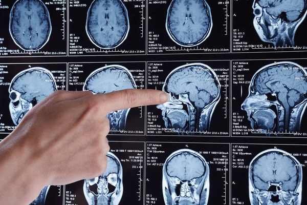 Magnetisk Resonanstomografi Scan Hjärnan Mri Huvud Scan — Stockfoto