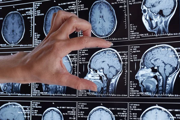 Magnetisk Resonanstomografi Scan Hjärnan Mri Huvud Scan — Stockfoto