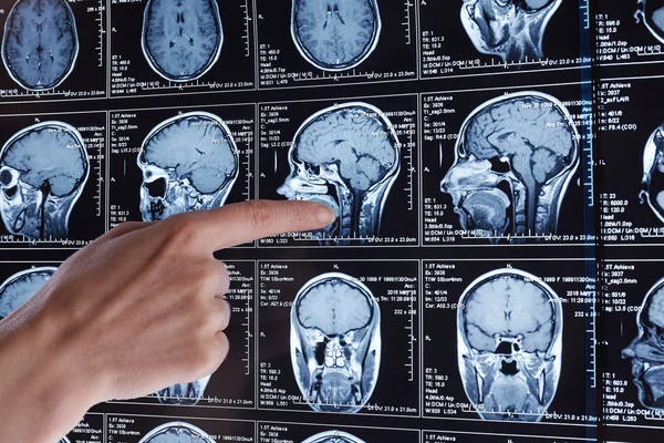 Resonansi Magnetik Memindai Otak Scan Kepala Mri — Stok Foto