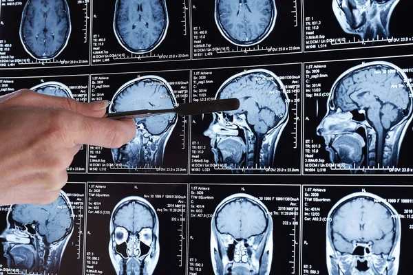 Magnetische Resonantie Scan Van Hersenen Mri Scan Hoofd — Stockfoto