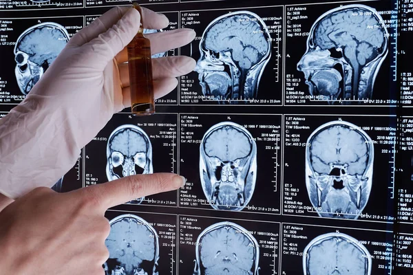 Magnetische Resonantie Scan Van Hersenen Mri Scan Hoofd — Stockfoto