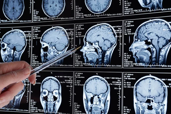 Magnetisk Resonanstomografi Scan Hjärnan Mri Huvud Scan — Stockfoto