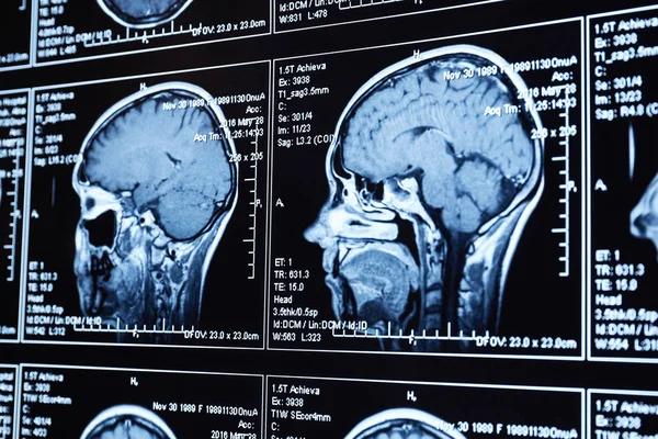 Exploración Por Resonancia Magnética Del Cerebro Resonancia Magnética Craneal — Foto de Stock