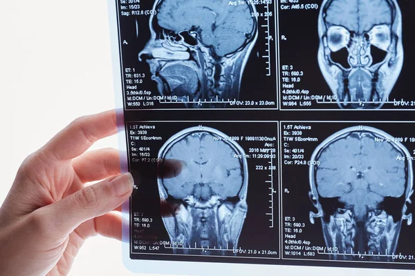 Magnetresonanztomographie Des Gehirns Mri Kopf Scan — Stockfoto