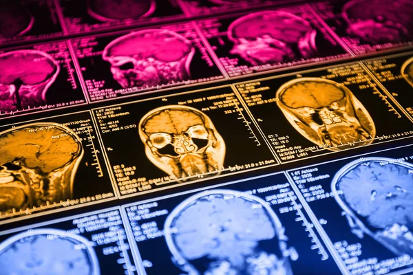 Magnetic resonance scan of the brain. MRI head scan.