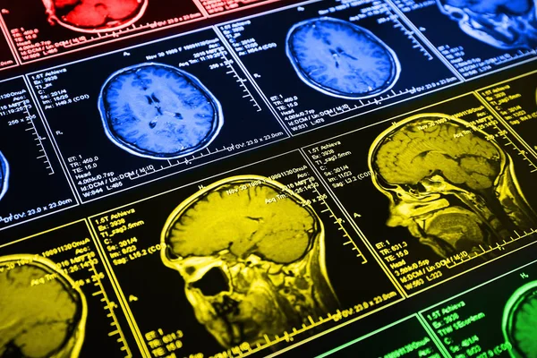 Manyetik Rezonans Taraması Beynin Mri Kafa Tarama — Stok fotoğraf
