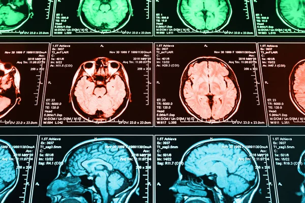 Resonansi Magnetik Memindai Otak Scan Kepala Mri — Stok Foto