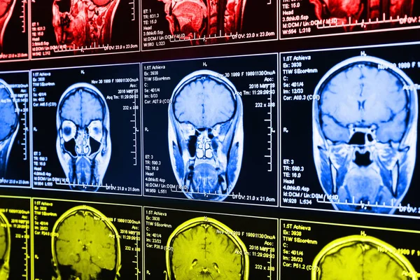Manyetik Rezonans Taraması Beynin Mri Kafa Tarama — Stok fotoğraf