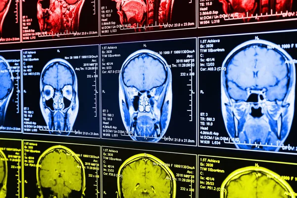 Exploración Por Resonancia Magnética Del Cerebro Resonancia Magnética Craneal — Foto de Stock