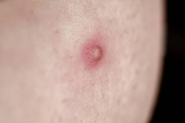 Pimple on the skin close-up — Stock Photo, Image