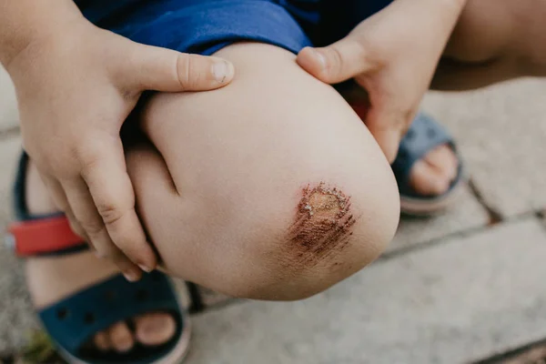 çocuk kaldırıma onun diz zarar. aşınma.