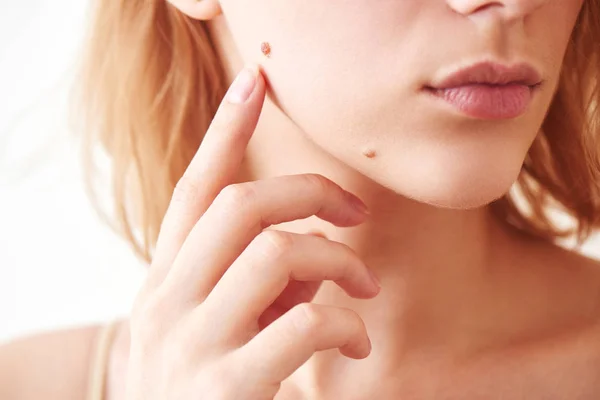 Mole Young Girl Face Skin Closeup — Stock Photo, Image