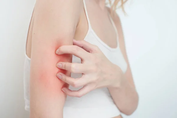 Woman Scratching Arm Close Concept Itchy Skin — Stock Photo, Image