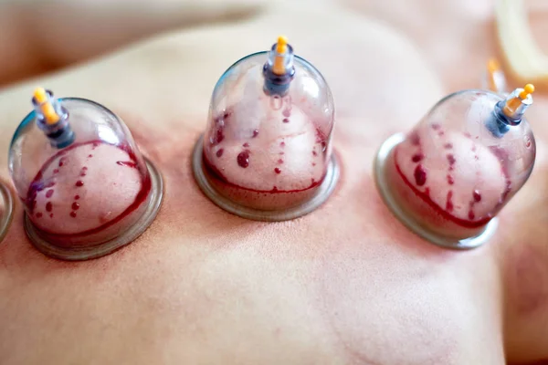 Kan alma, hijama ya da flebotomi. Hajam ustası genç bir bayana kupa terapisi uyguluyor. İslam tıbbı