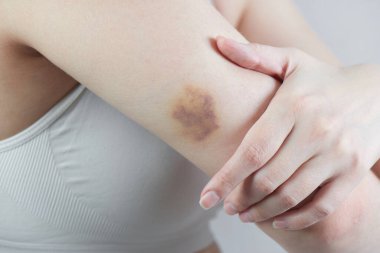 Girl shows a real bruise on her hand closeup clipart