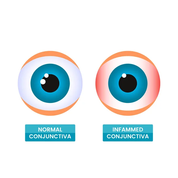 Una conjuntiva inflamada sana y enferma del ojo. El concepto de la enfermedad, alergias estacionales, enrojecimiento ocular. ilustración vectorial plana aislada — Archivo Imágenes Vectoriales