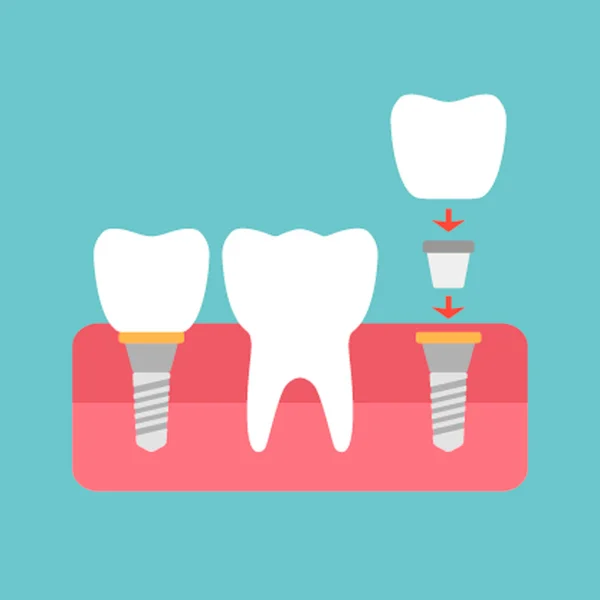 Οδοντικό εμφύτευμα με υγιή εικόνα διανυσματική σιλουέτα. έννοια της αποκατάστασης και της οδοντιατρικής θεραπείας. σύγχρονη οδοντιατρική — Διανυσματικό Αρχείο