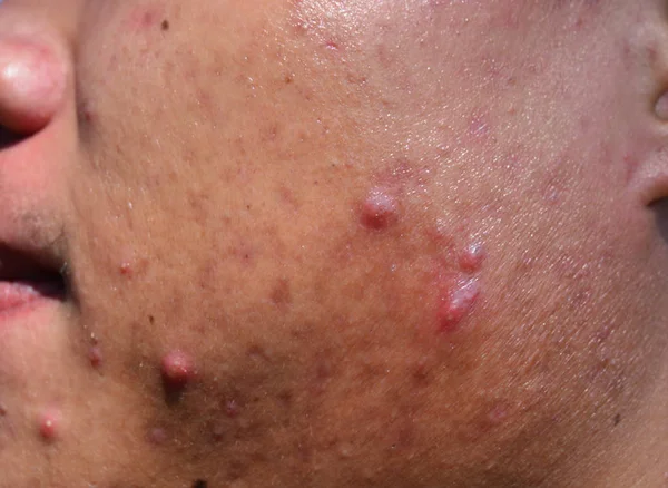 Acne sul viso della pelle — Foto Stock