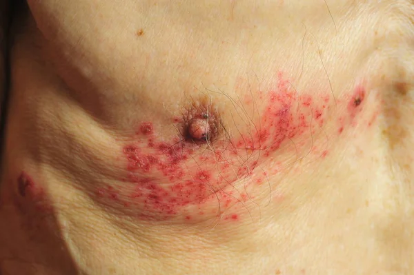 L'herpes zoster è un'infezione virale che provoca un rash doloroso — Foto Stock