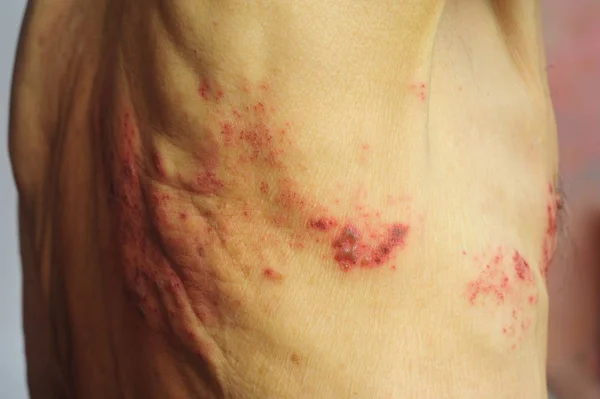 Shingles is a viral infection that causes a painful rash — Stock Photo, Image