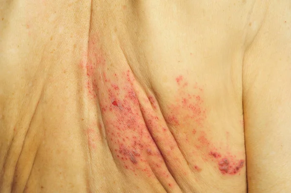 Черепица это вирусная инфекция, которая вызывает болезненную сыпь. — стоковое фото