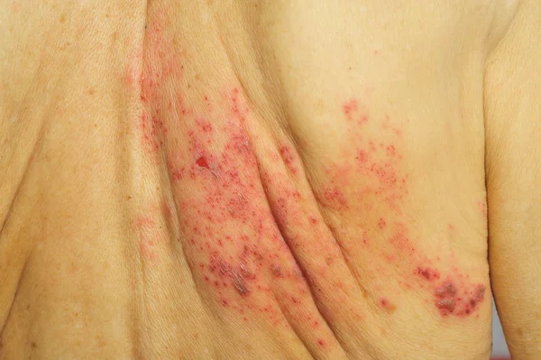 Черепица это вирусная инфекция, которая вызывает болезненную сыпь. — стоковое фото