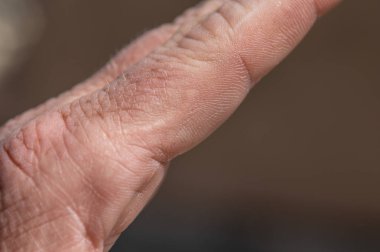 El üzerinde yara dokusu