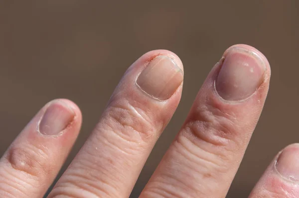 Scar Tissue on Crushed Finger That has Healed