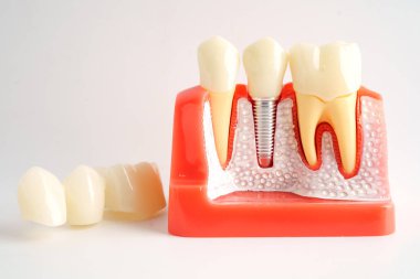 Diş implantı, çeneye yapay diş kökleri.